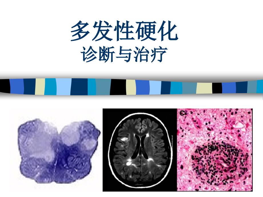 多发性硬化最新疗法探索与突破进展