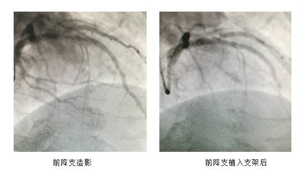 心脏血管堵塞最新开通技术，重塑生命之流的希望曙光